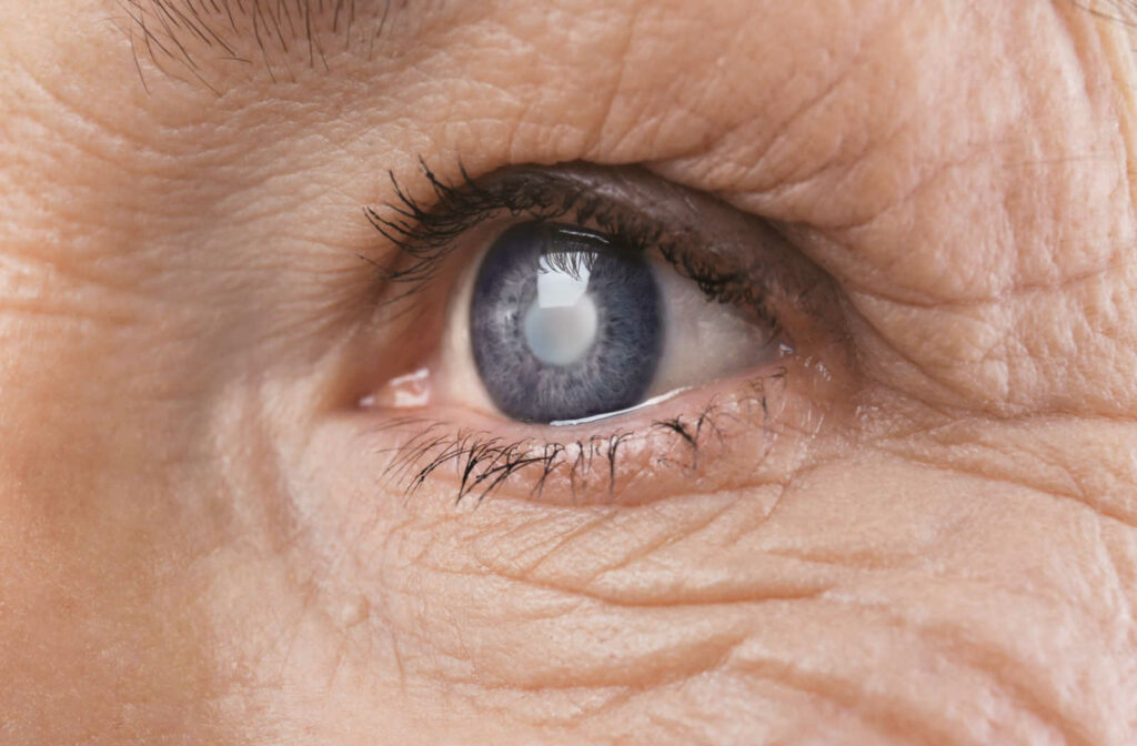 A close up of an aging eye with cataracts