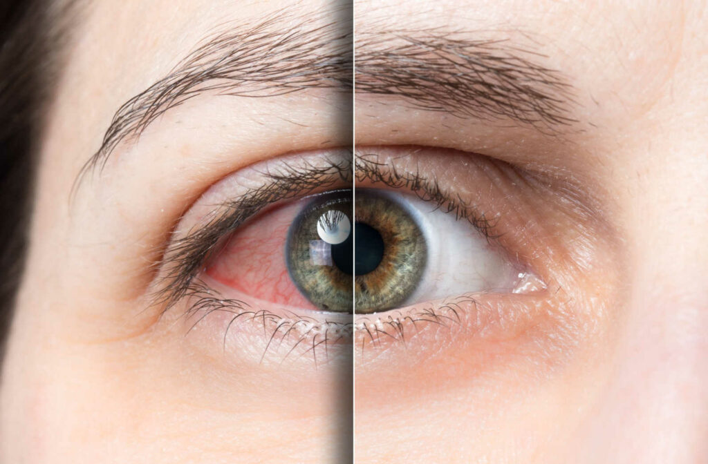 A side by side image of an eye experiencing dry symptoms from overwearing contact lenses compared to a normal eye