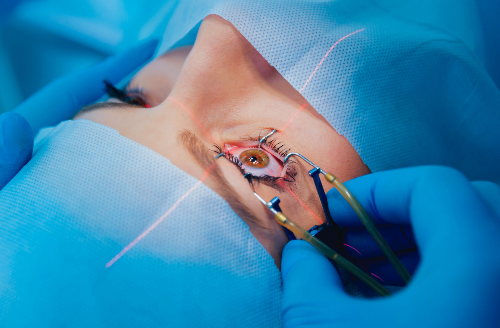 How Long Does LASIK Eye Surgery Last? | League City