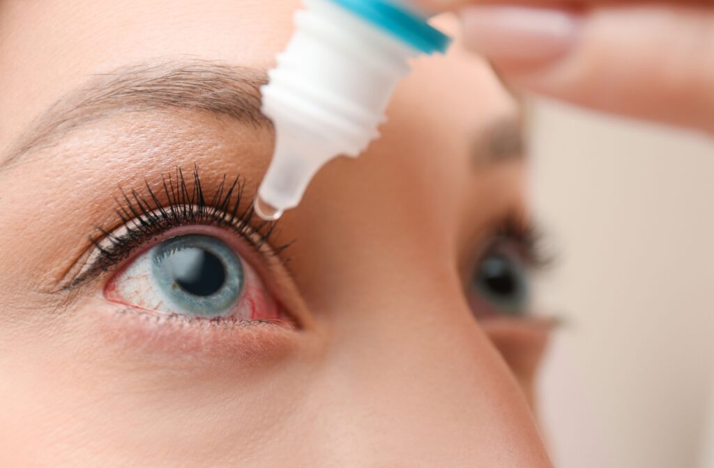 A close up of a woman putting eye drops into her eye due to an eye infection