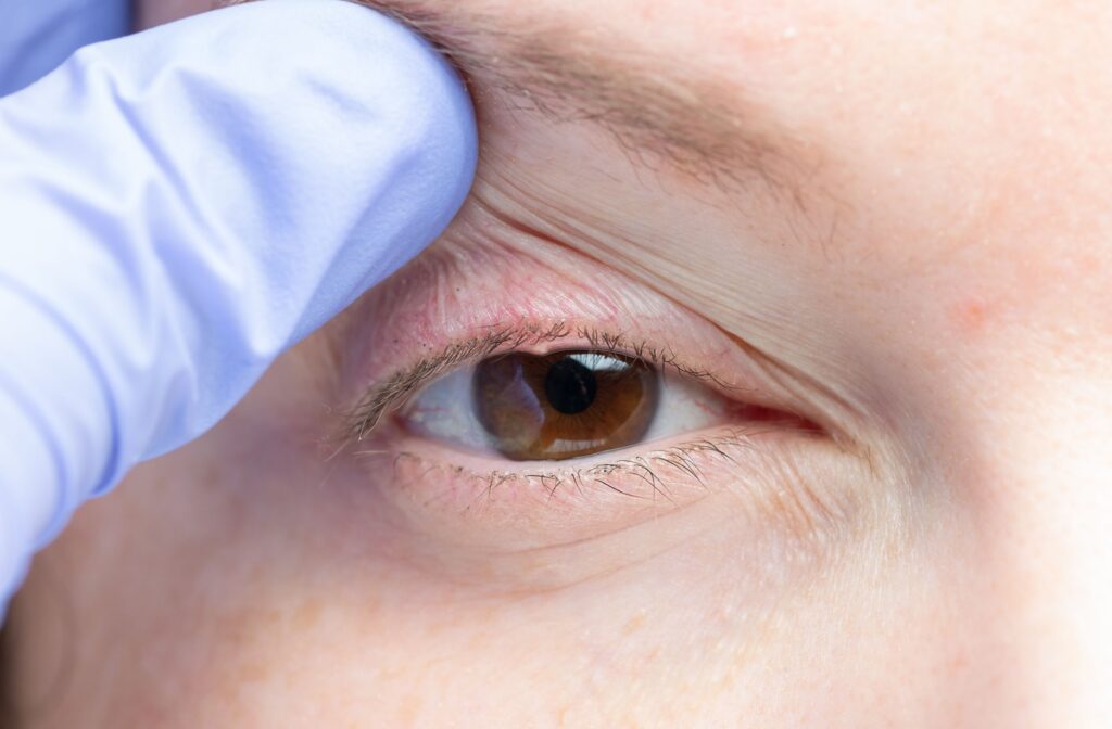 A close up of an eye doctor using a gloved hand to lift a patient's eyelid.